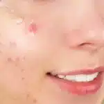 What is fumaric acid used for on the skin?